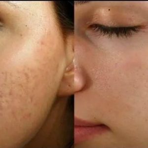 مدل پاکسازی پوست در سمنان سایت آگهی و خرید و فروش دزار سمنان .